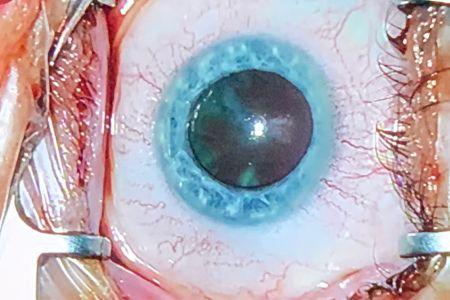 Aranyszem Optika Optilux szemműtétek szürkehályog műtét
